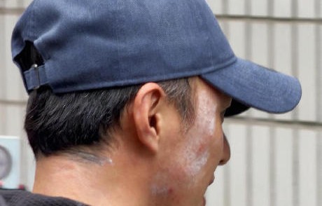 叶祖新这次古装头套胶水受伤的具体情况有多严重？|胶水过敏|古装剧拍摄|头套过敏|古装剧幕后|面部破皮